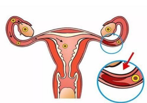 天津正规代怀：﻿乳房下垂怎样恢复紧实,小方法告别下垂
